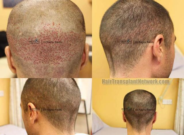 Hair restoration procedure before and after pictures