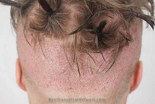 Hair restoration procedure before and after pictures