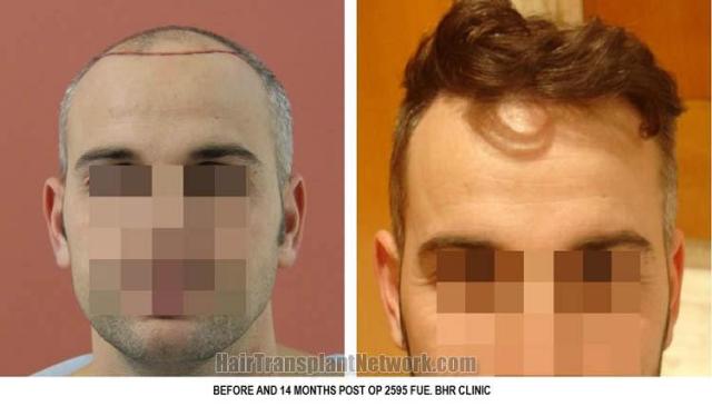 Hair restoration procedure before and after results