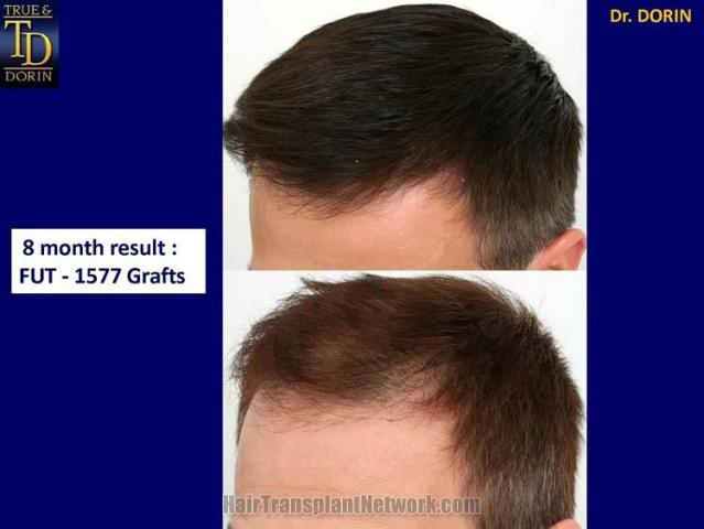 Left view - Before and after follicular transplant surgery