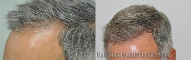 Left view before and after hair transplantation images