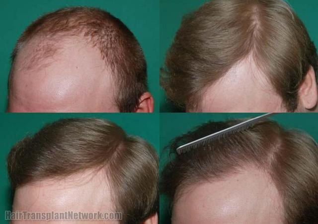 Before and after surgical hair restoration images