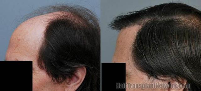 Hair transplantation surgery before and after images