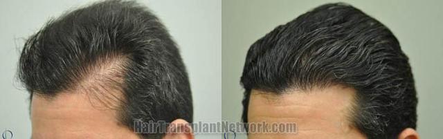 Hair transplantation surgery before and after pictures