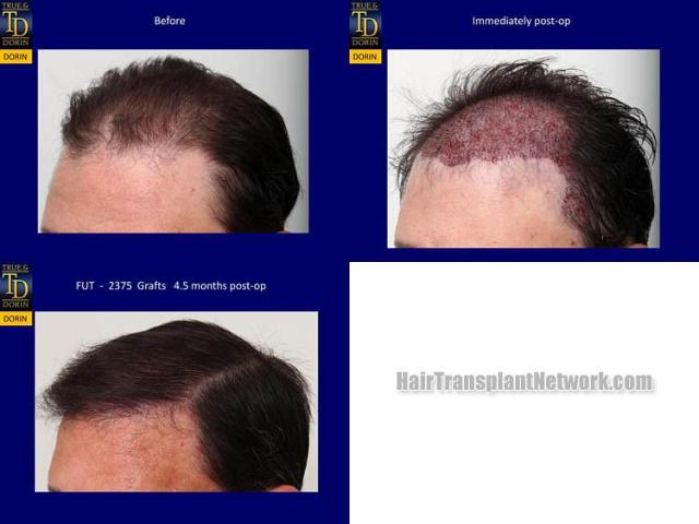 Hair transplantation surgery before and after pictures