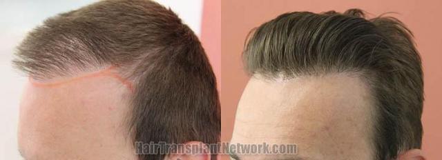 Hair transplantation surgery before and after pictures