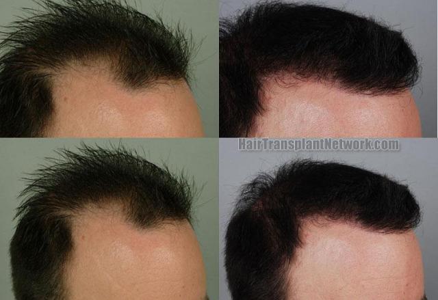 Before and after hair restoration procedure
