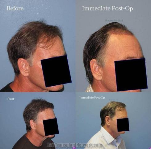 Before and after surgical hair restoration images