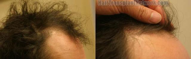 Hair restoration procedure before and after results