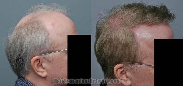 Hair transplantation surgery before and after photos