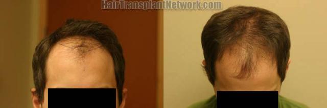 Hair restoration procedure before and after results