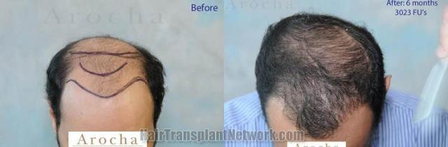 Hair transplantation surgery before and after photos