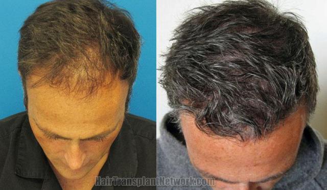 Hair transplantation surgery before and after images