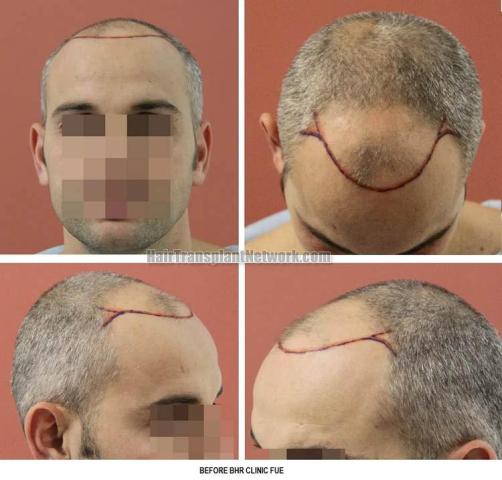 Hair transplantation surgery before photos