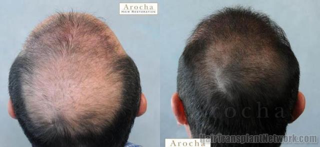 Hair transplantation surgery before and after images