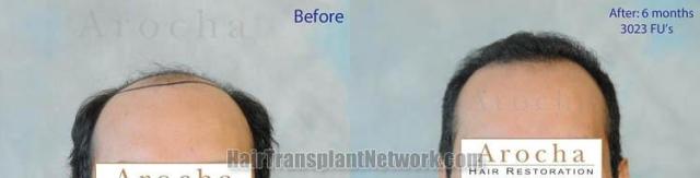 Hair restoration procedure before and after results