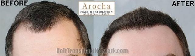 Hair transplantation surgery before and after photos