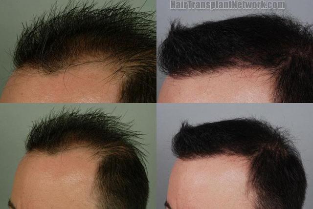 Photos of before and after hair transplantation surgery 