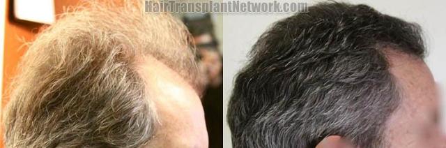 Right view before and after hair replacement surgery