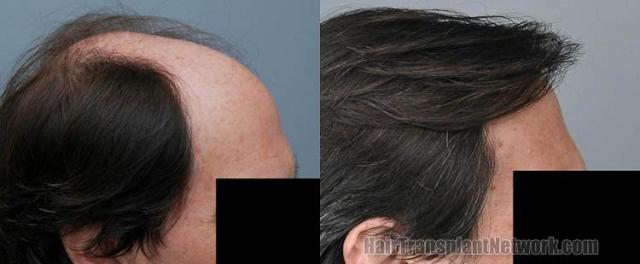 Hair transplantation surgery before and after photos