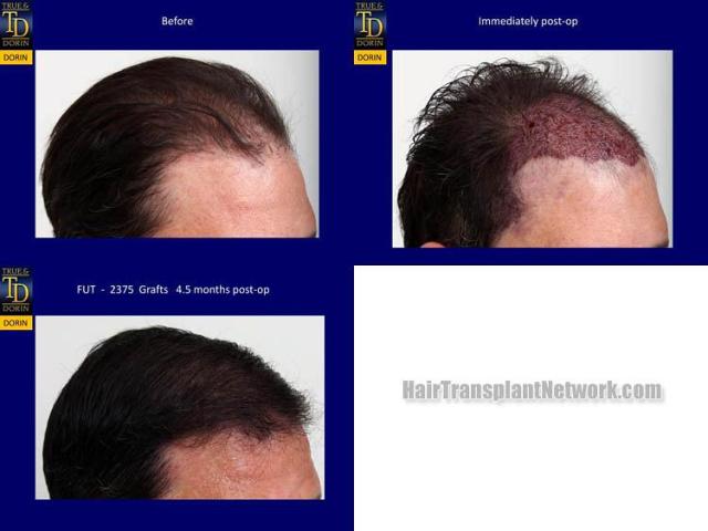 Hair transplantation surgery before and after images