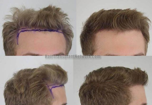 Hair transplantation surgery before and after images