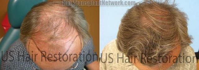 Before and after hair restoration pictures top view