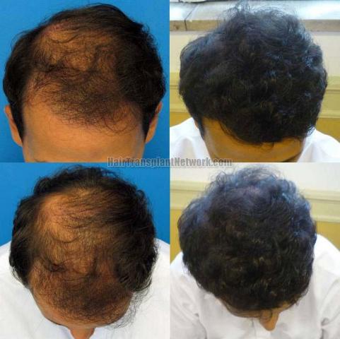 Top view before and after hair restoration results