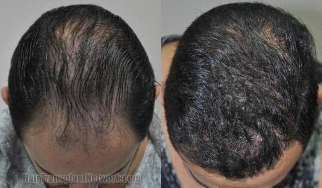 Hair restoration procedure before and after results