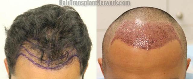 Hair transplantation surgery before and after photos