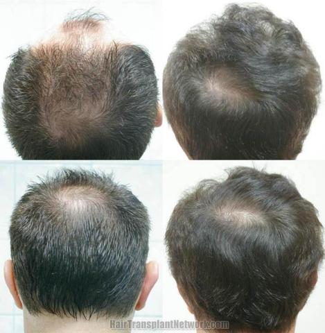 Hair transplant procedure result photographs