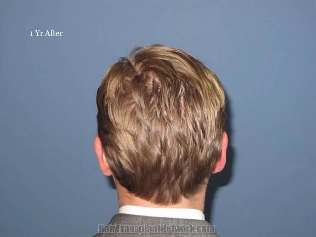 Hair transplant surgery after photo 