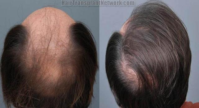 Hair transplantation surgery before and after pictures