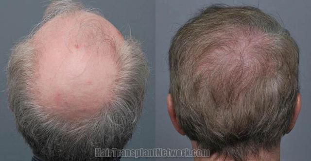 Back view before and after hair transplantation photos