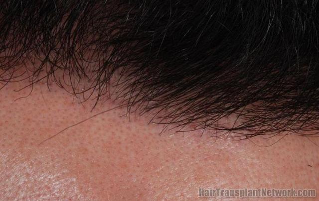 Closeup of hairline after 