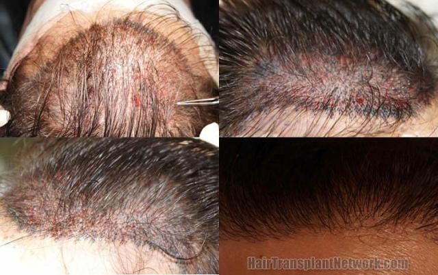 Hair restoration procedure before and after pictures