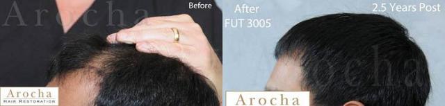 Hair transplantation surgery before and after images