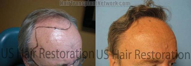 Right view before and after hair restoration procedure