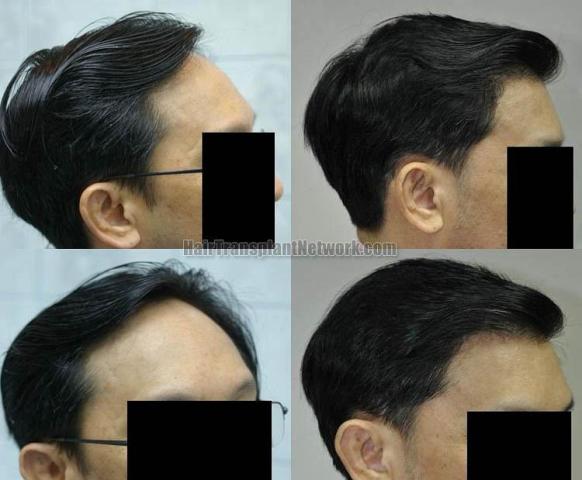 Before and after hair transplant procedure images