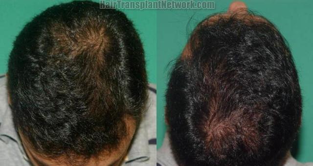 Hair restoration procedure after results