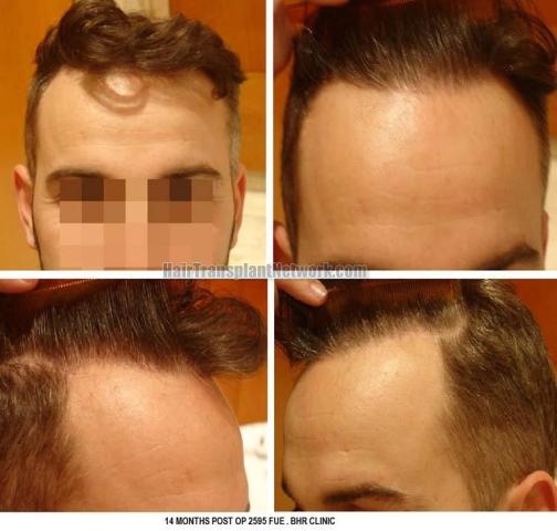 Hair transplantation surgery after photos