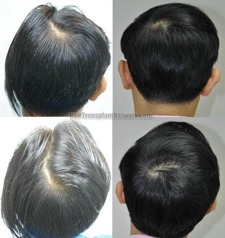 Back view before and after hair transplantation photos