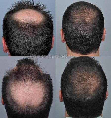 Hair restoration procedure before and after pictures