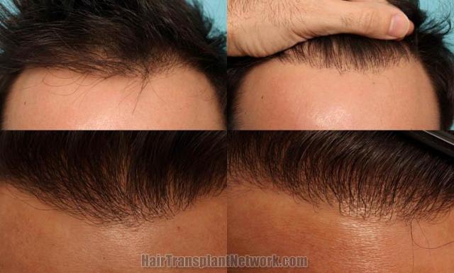 Hair restoration procedure before and after results