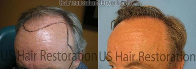 Before and after hair replacement procedure - Left view,