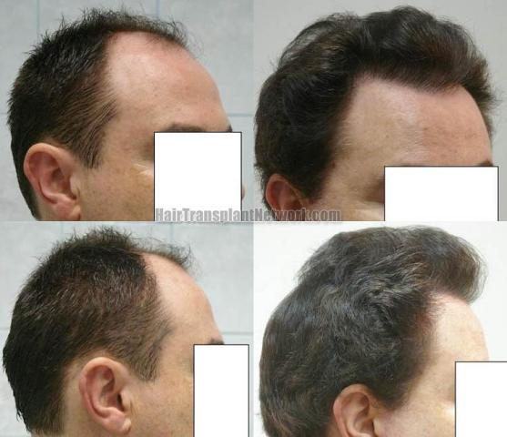 Before and after hair transplantation procedure