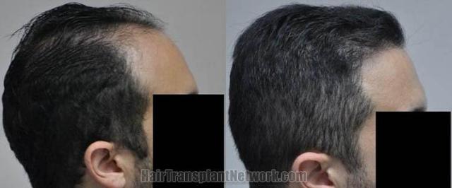 Hair transplantation surgery before and after photos