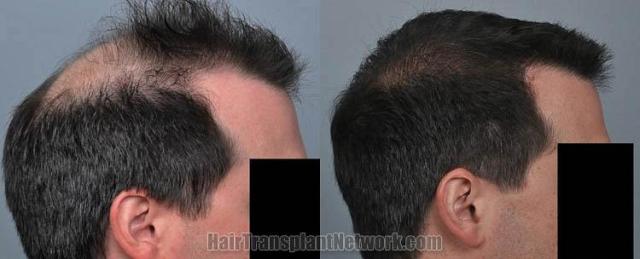 Hair transplantation surgery before and after images