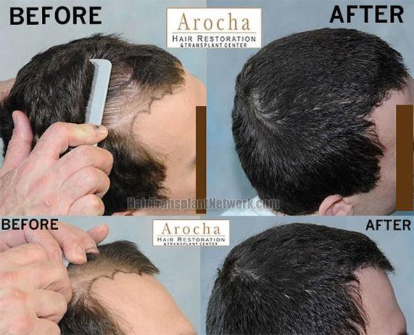 Hair transplantation surgery before and after pictures