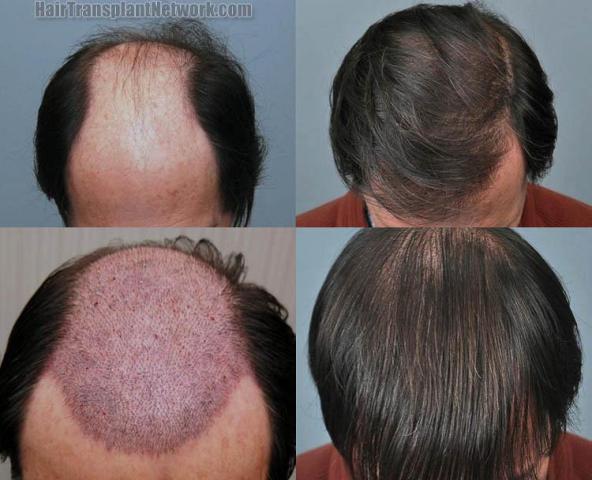 Before and after hair transplant procedure images